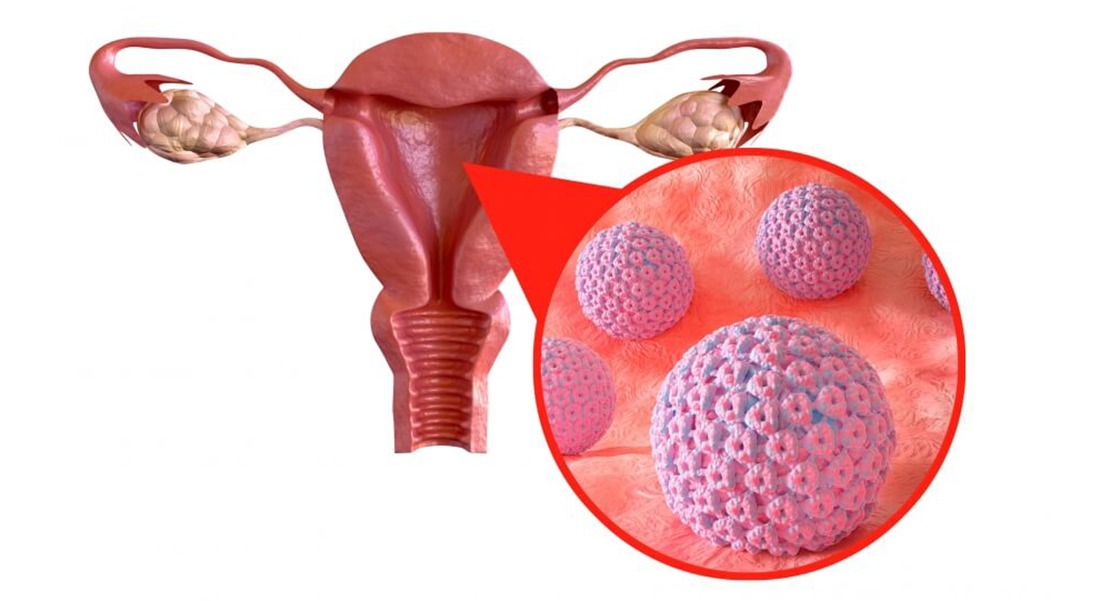 Cervical Cancer